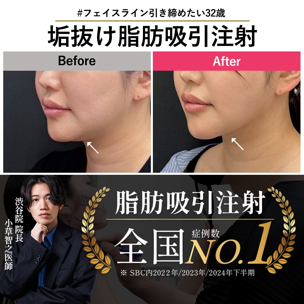 【脂肪吸引注射の名医】もたつきに悩むアラサー女子の脂肪吸引注射