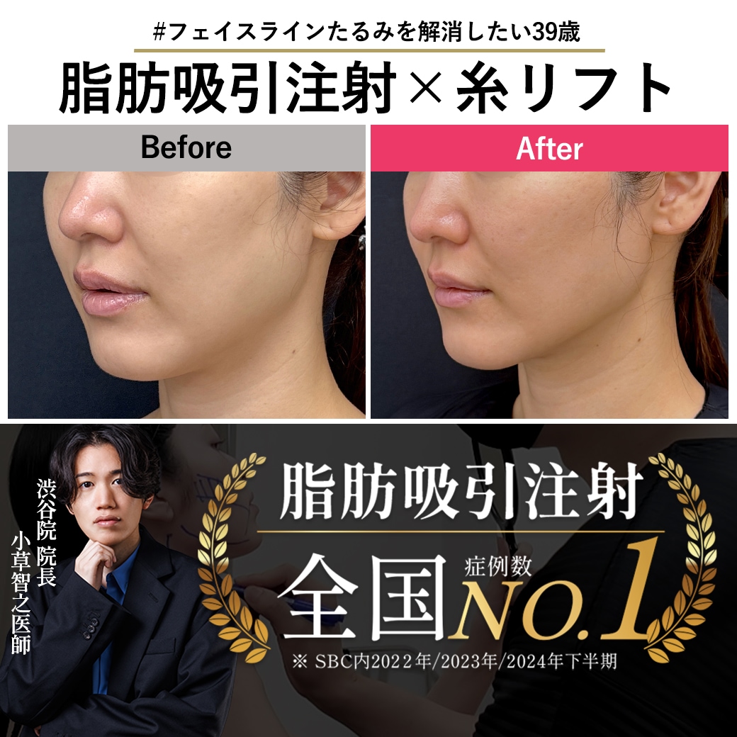 【脂肪吸引注射の名医】アラフォーの輪郭悩みを脂肪吸引注射で解決
