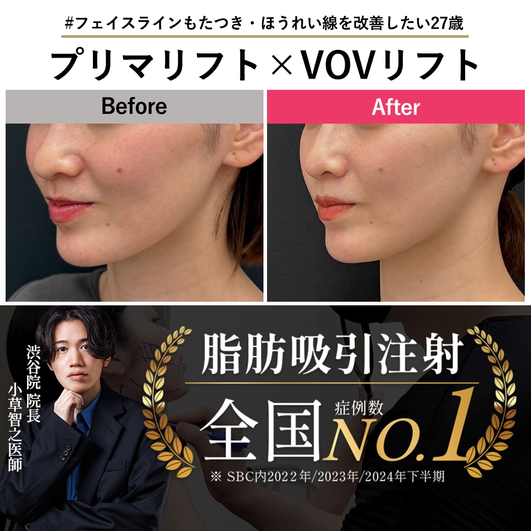 【糸リフトの名医】フェイスラインもたつき・ほうれい線を改善