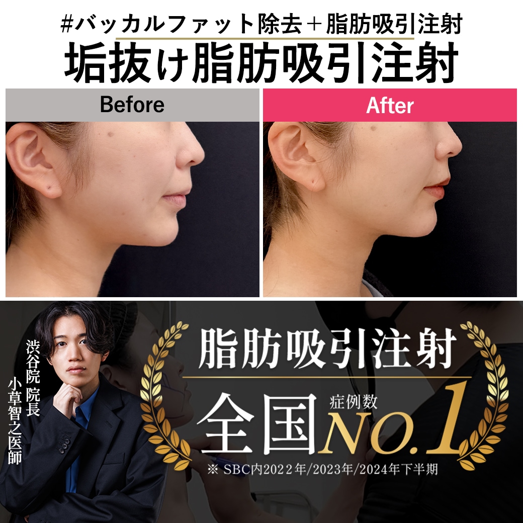 【脂肪吸引注射の名医】24歳の顔痩せ成功！バッカルファット除去併用で垢抜け【脂肪吸引注射が上手いおぐさ先生】