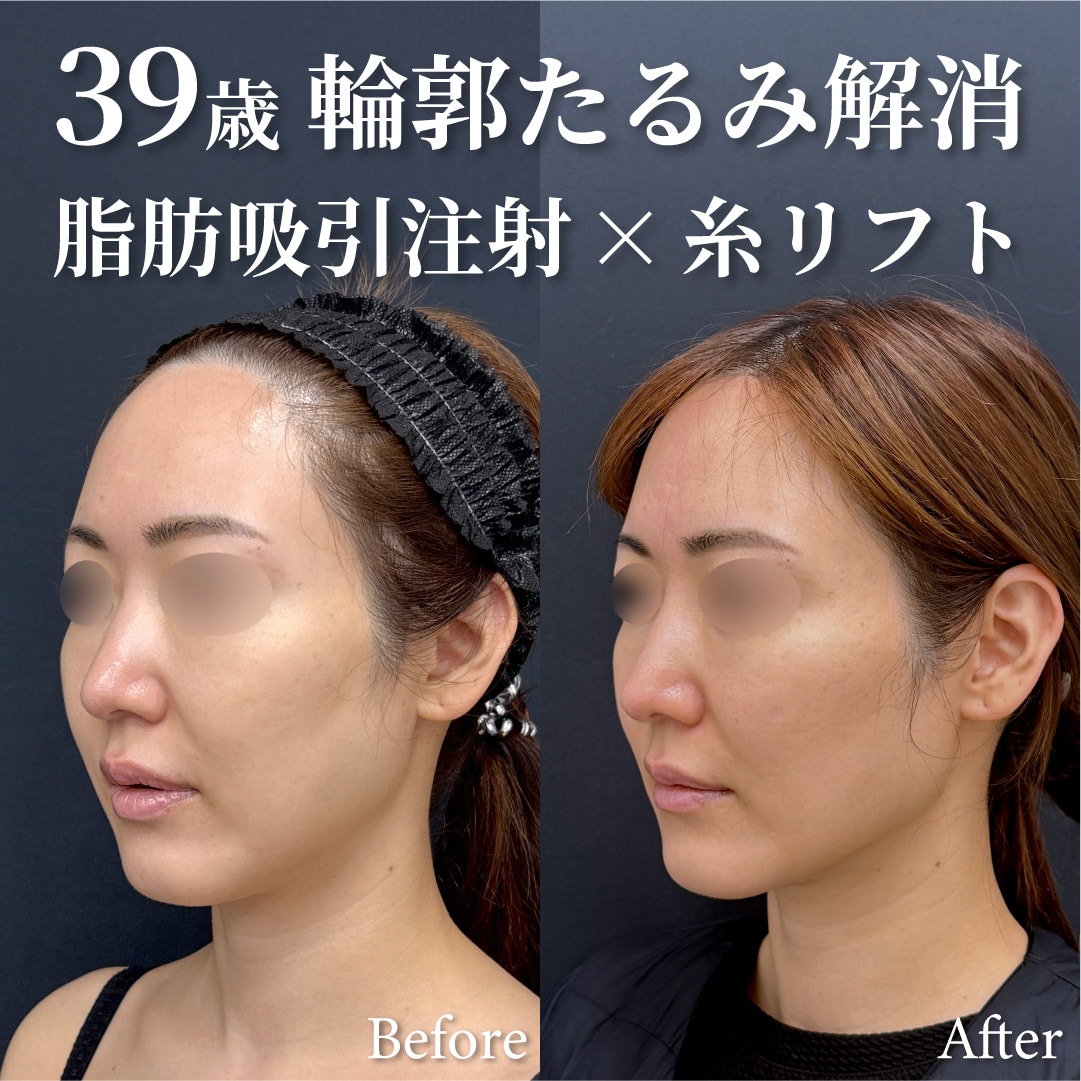 39歳女性のモニター様