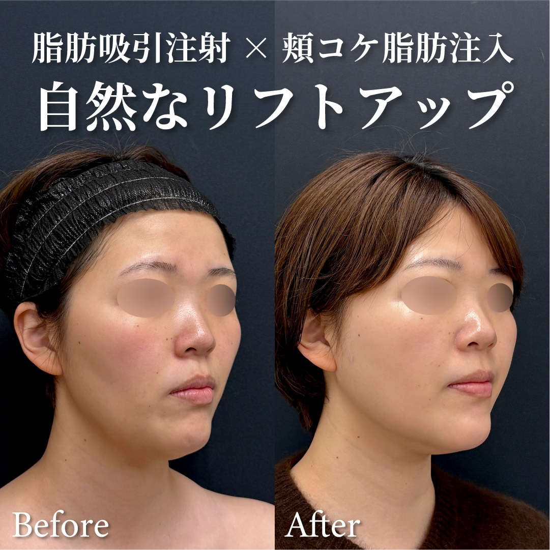 30歳女性のモニター様