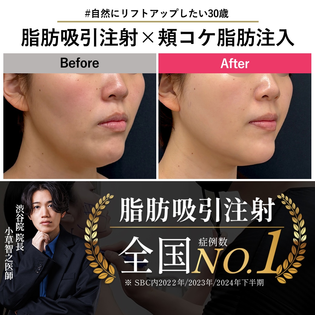 【脂肪吸引注射の名医】頬コケ脂肪注入併用で自然にリフトアップ