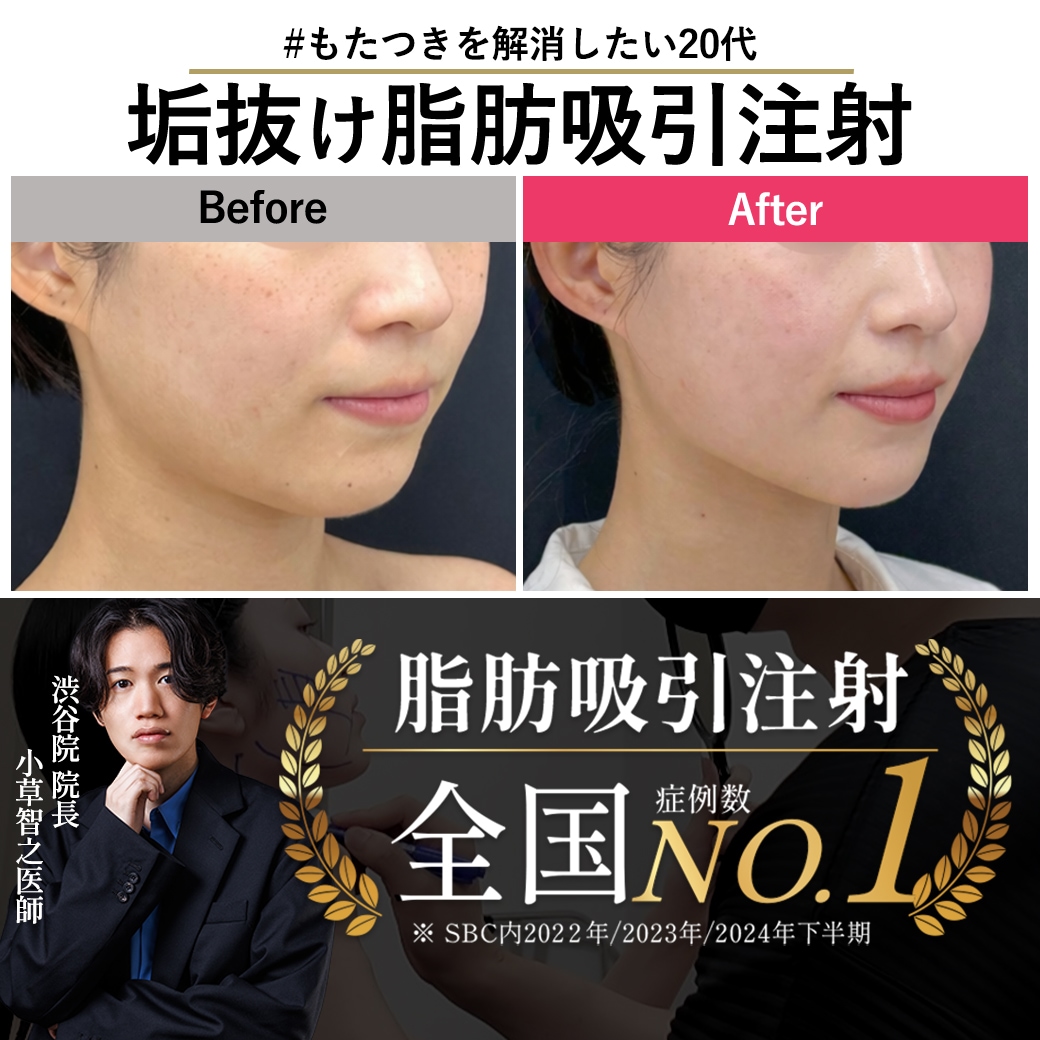 【脂肪吸引注射の名医】貴重！脂肪吸引注射2年後の症例見せます【脂肪吸引注射が上手い小草先生】