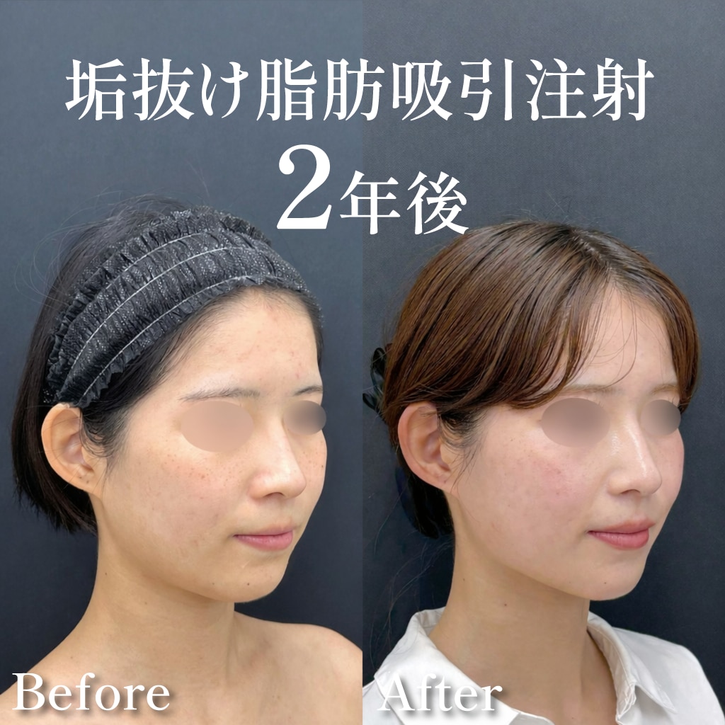 20代女性のモニター様