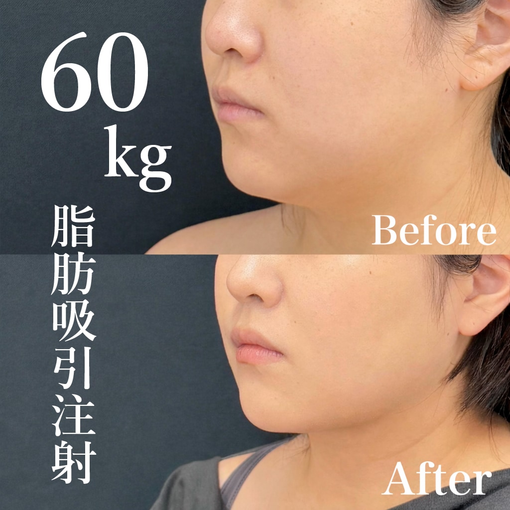 【脂肪吸引注射の名医】60kgでもできる脂肪吸引注射【脂肪吸引注射が上手いおぐさ先生】