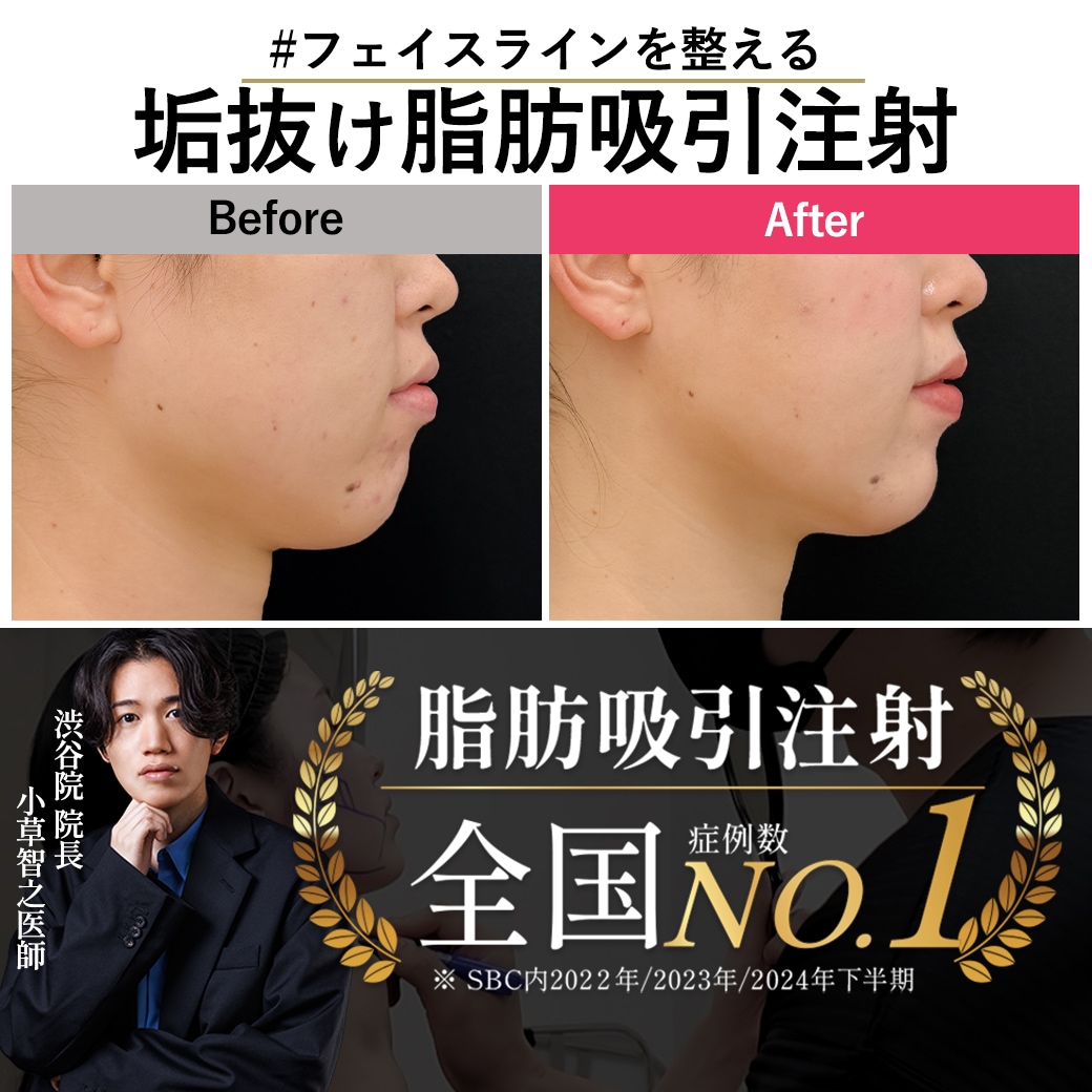 【脂肪吸引注射の名医】25歳のフェイスライン激変！小顔Vライン【脂肪吸引注射が上手いおぐさ先生】