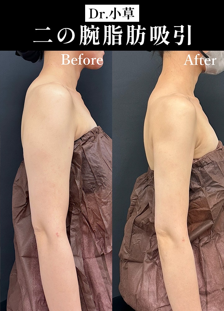 【二の腕脂肪吸引の名医】次の日から働ける！最小ダウンタイムの脂肪吸引【二の腕脂肪吸引が上手いおぐさ先生】