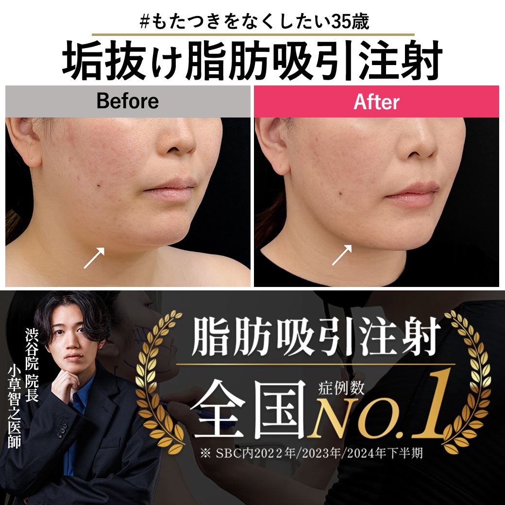 【脂肪吸引注射の名医】脂肪吸引注射×エンブレイスRFで30代の老け顔解消