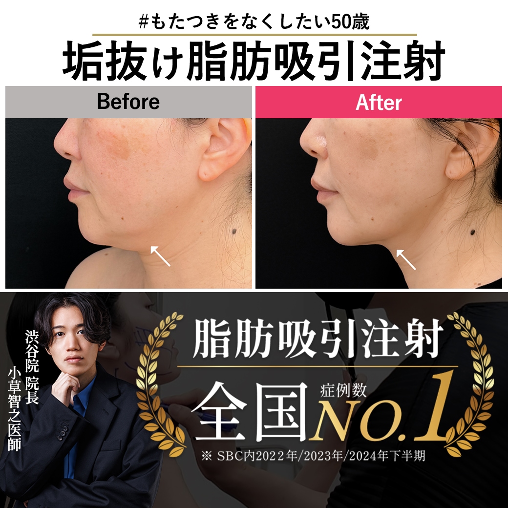 【脂肪吸引注射の名医】脂肪吸引注射×糸リフトで50歳でも若々しくスッキリ！【脂肪吸引注射が上手いおぐさ先生】