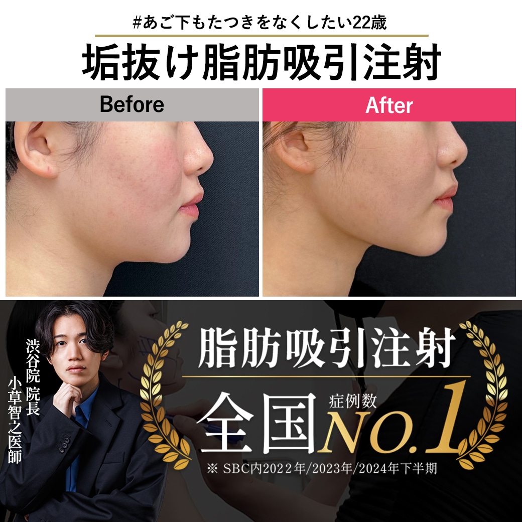 【脂肪吸引注射の名医】最小ダウンタイムで脂肪吸引級の変化