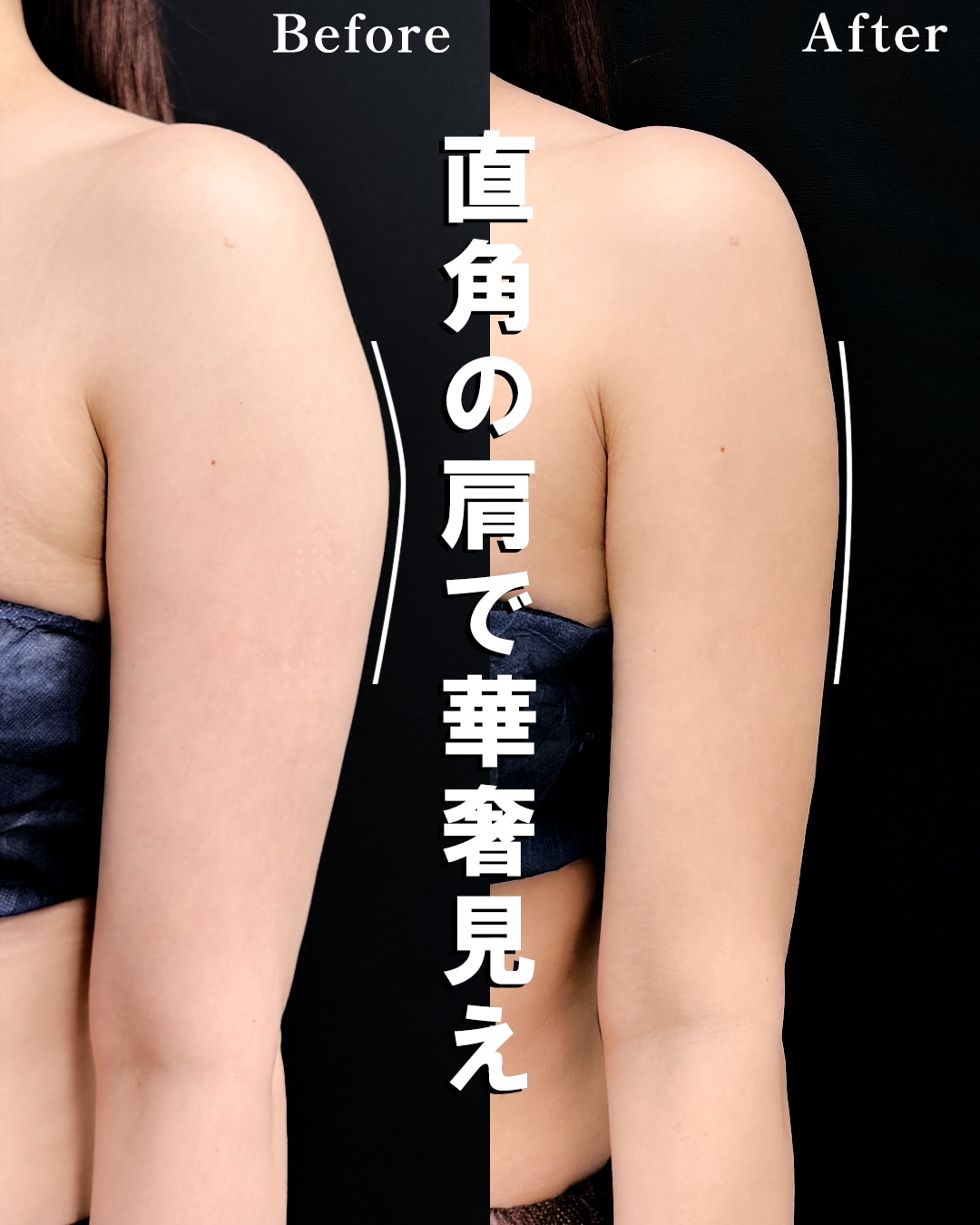 【二の腕脂肪吸引の名医】32歳「肩の張り出し」を撃退!直角ラインの華奢見えシルエット
