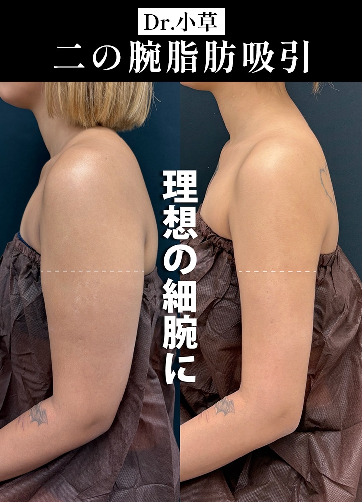 【二の腕脂肪吸引の名医】どんな服も着こなせる細腕に【二の腕脂肪吸引が上手いおぐさ先生】