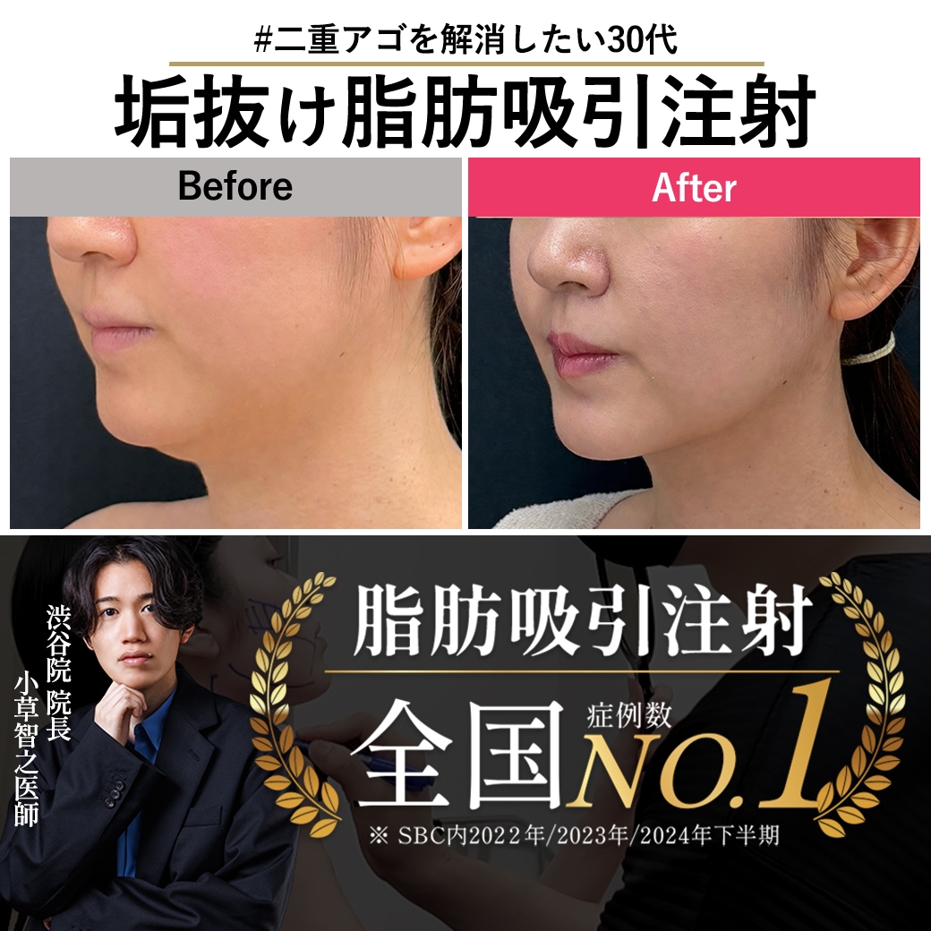 【脂肪吸引注射の名医】アラサーの二重アゴを脂肪吸引注射で解消！【脂肪吸引注射が上手い小草先生】