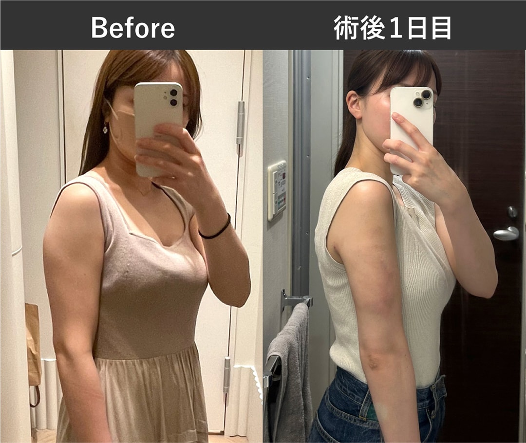 <h3>二の腕付け根セット</h3>