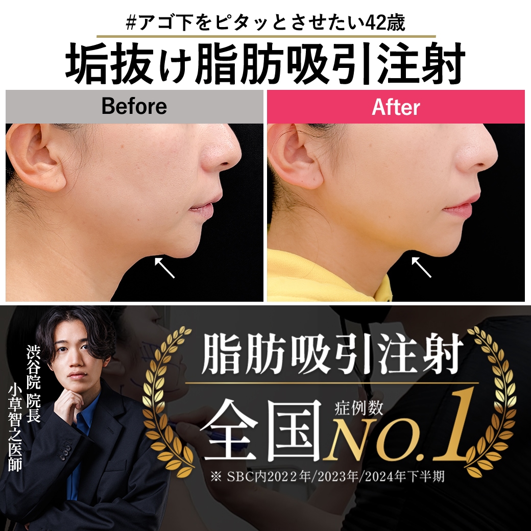 【脂肪吸引注射の名医】脂肪吸引注射×糸リフトで40代のもたつき解消