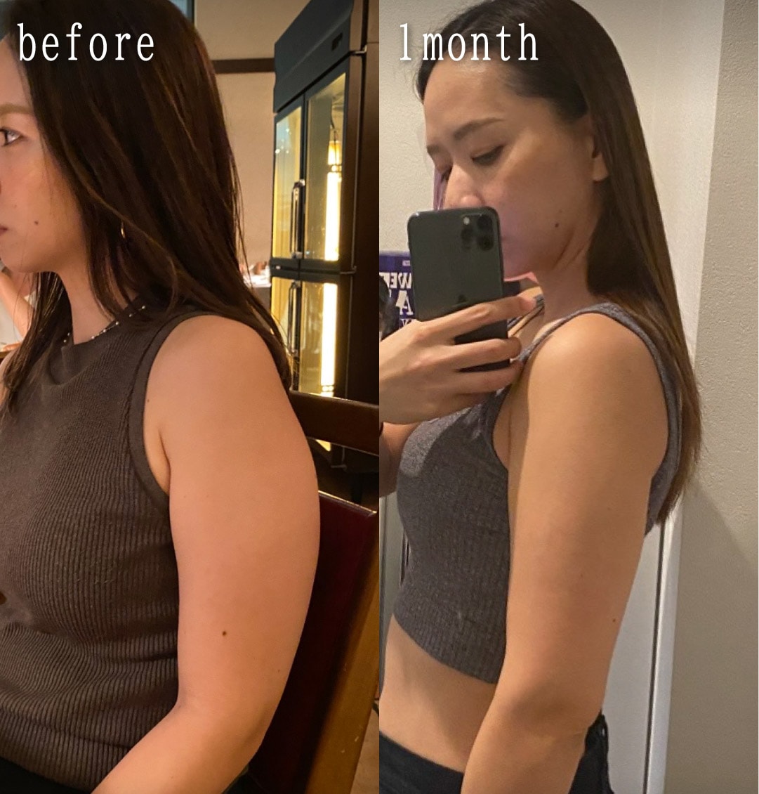 脂肪吸引注射で振袖たるみ解消！32歳女性のダウンタイム経過