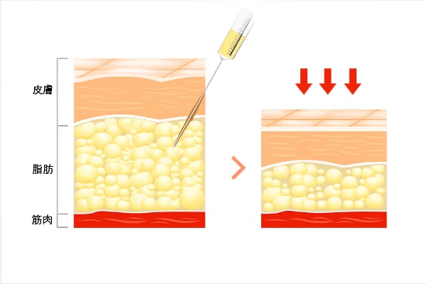 脂肪溶解注射とは
