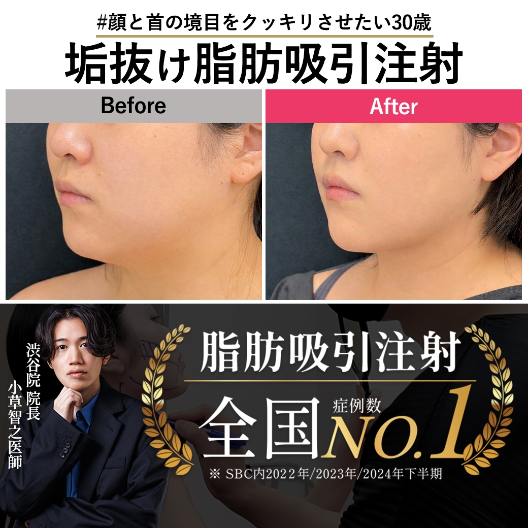 【脂肪吸引注射の名医】60kgでもできる脂肪吸引注射【脂肪吸引注射が上手いおぐさ先生】