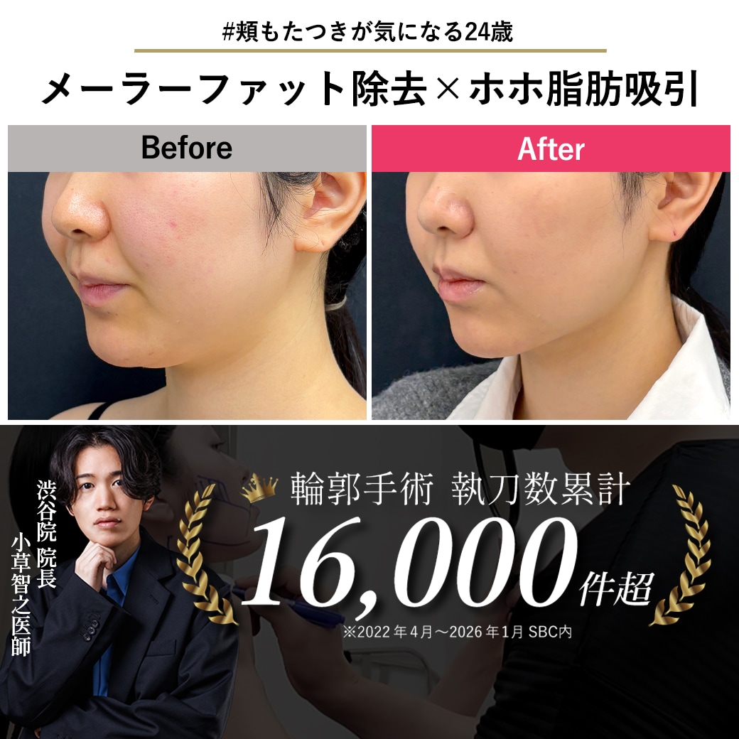 【顔の脂肪吸引の名医】メーラーファット除去×ホホ脂肪吸引でもたつき解消【脂肪吸引が上手いおぐさ先生】