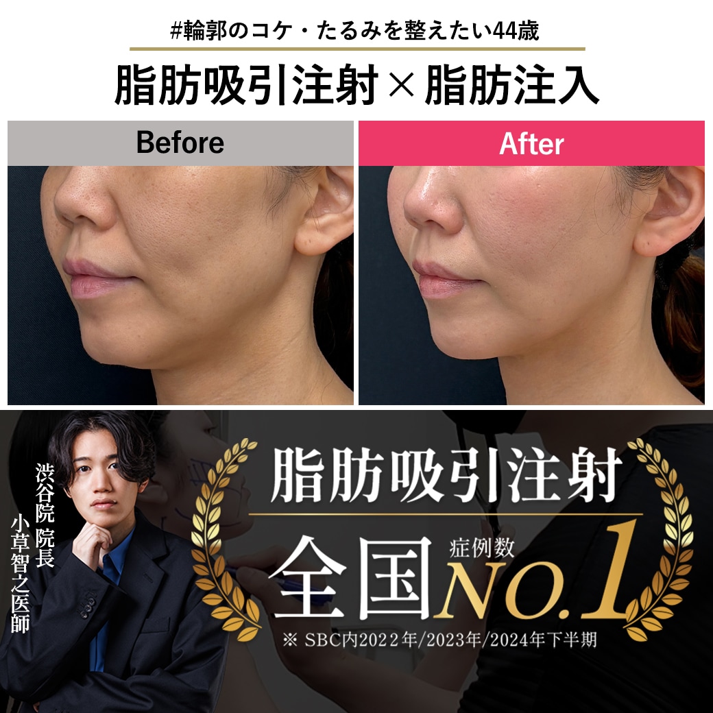 【脂肪吸引注射の名医】アラフォー女性の輪郭悩みを解決