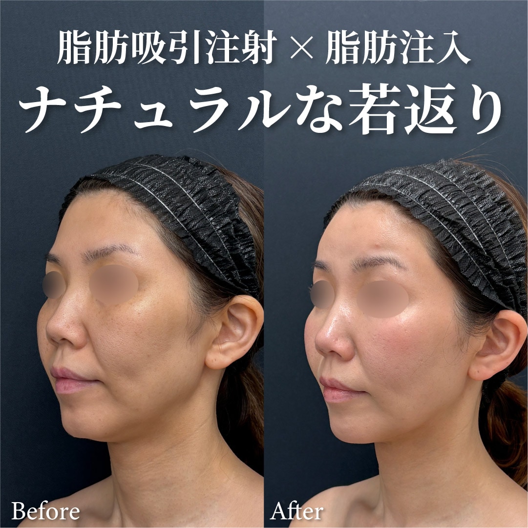 44歳女性のモニター様