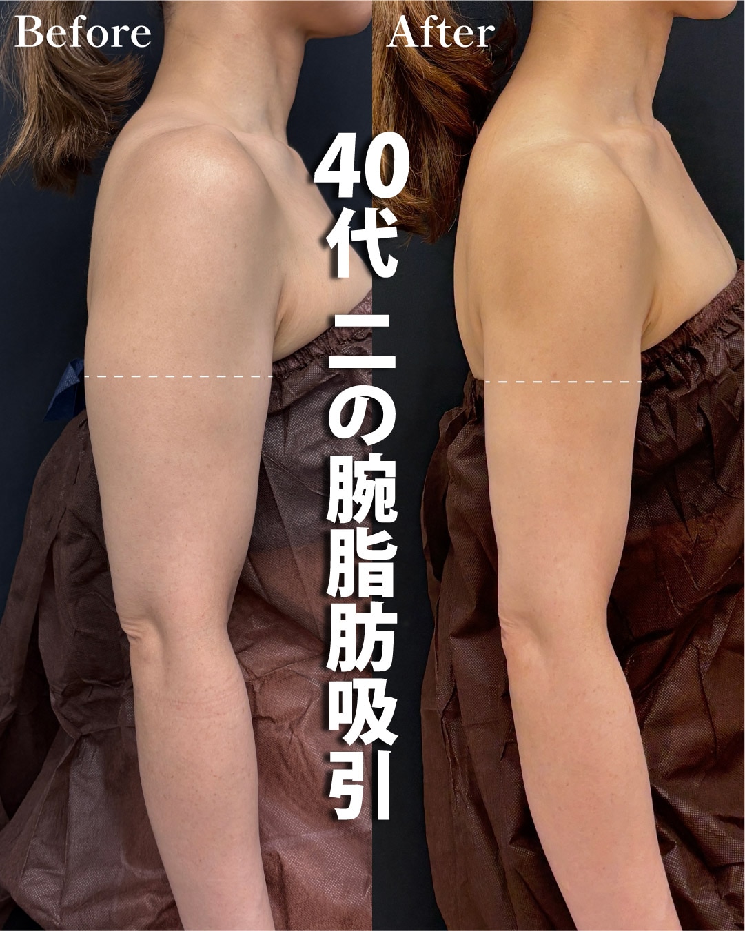 【二の腕脂肪吸引の名医】アラフォー女性のボディメイク【二の腕脂肪吸引が上手いおぐさ先生】