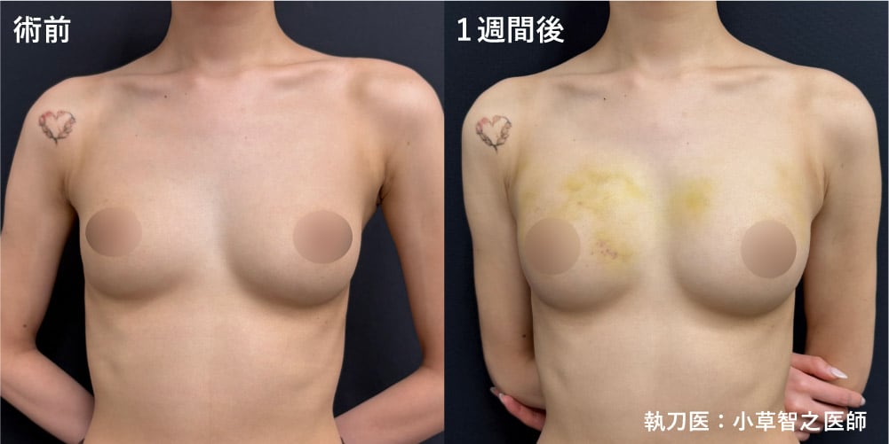 25歳女性 SBCリッチ豊胸