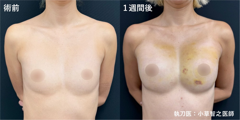 50歳女性　コンデンスリッチ豊胸