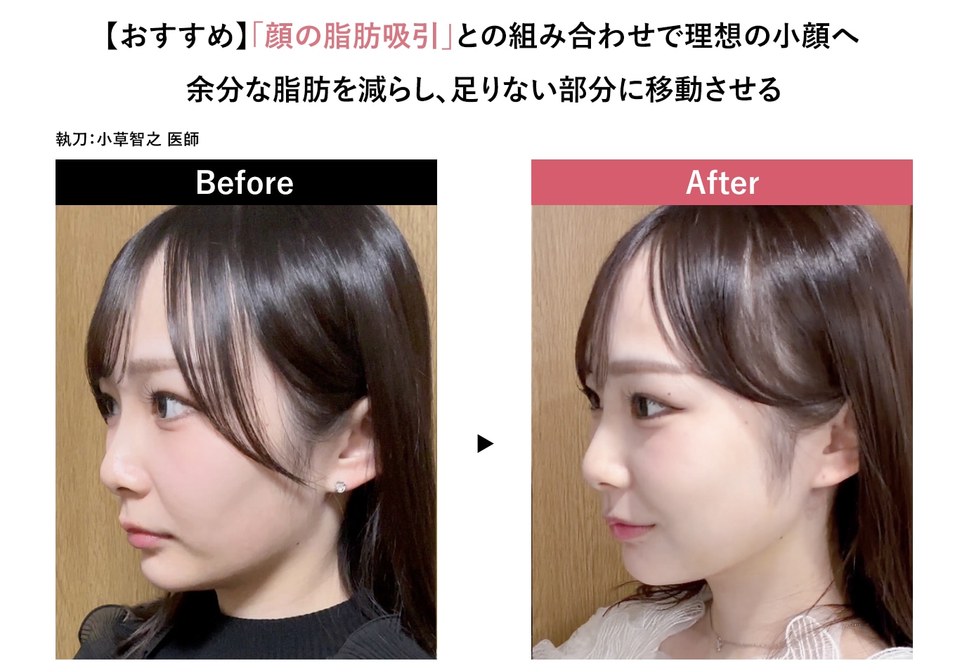 いらない脂肪を、ほしい場所へ。