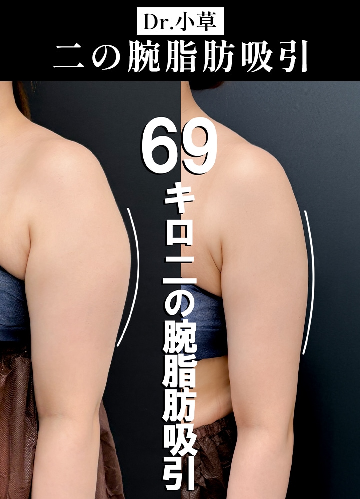 【二の腕脂肪吸引の名医】32歳・体重69kgからの劇的変化！「体型に合わせて」華奢見えを叶える全身バランス術