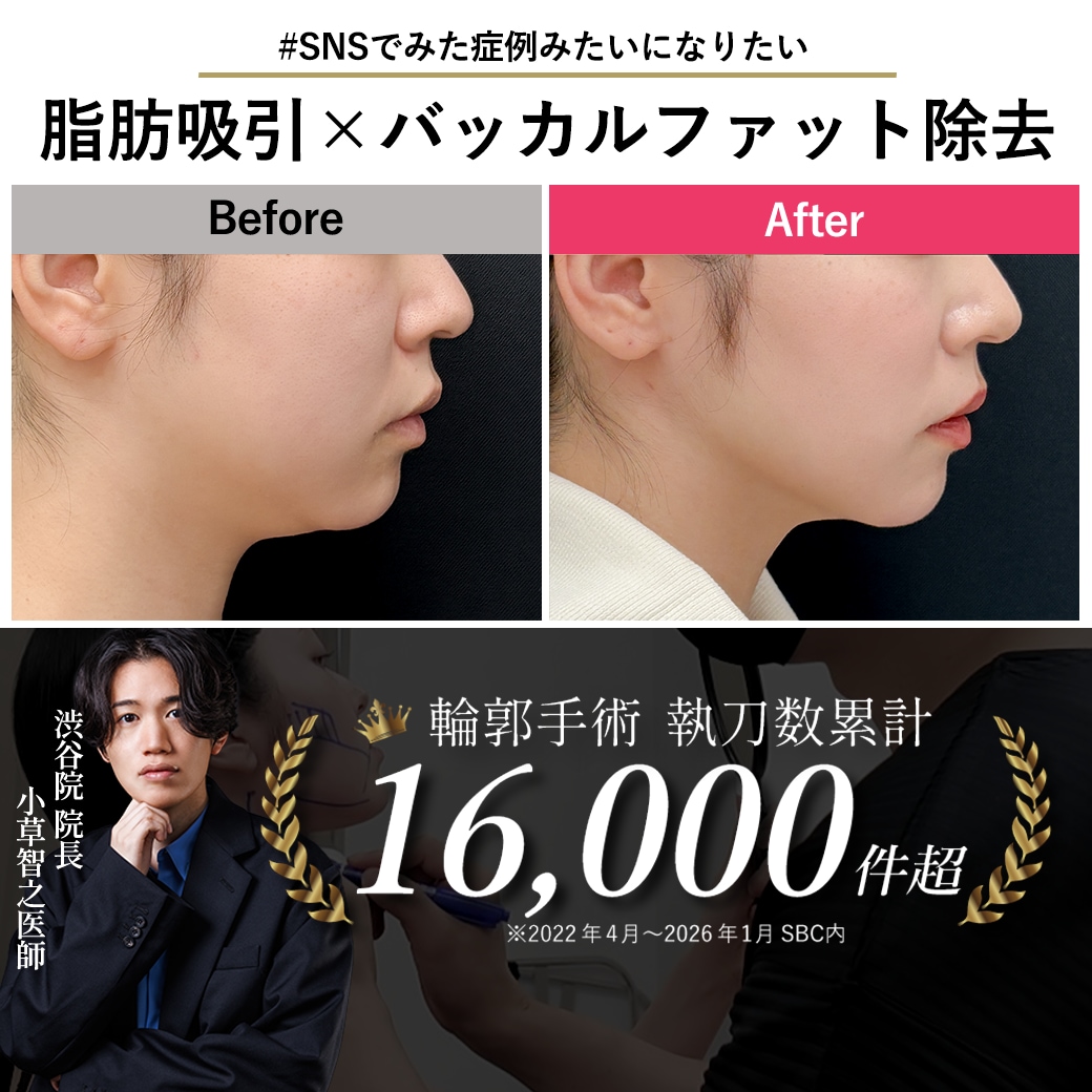【顔の脂肪吸引の名医】バッカルファット除去で劇的小顔!24歳が選んだ「おぐさ先生」【脂肪吸引が上手いおぐさ先生】