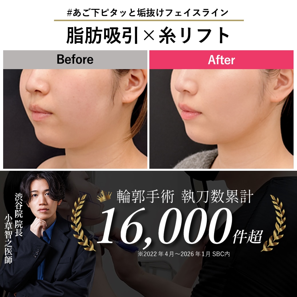 【顔の脂肪吸引の名医】ホホ・あご下吸引で理想の小顔！フェイスライン激変3か月【脂肪吸引が上手いおぐさ先生】