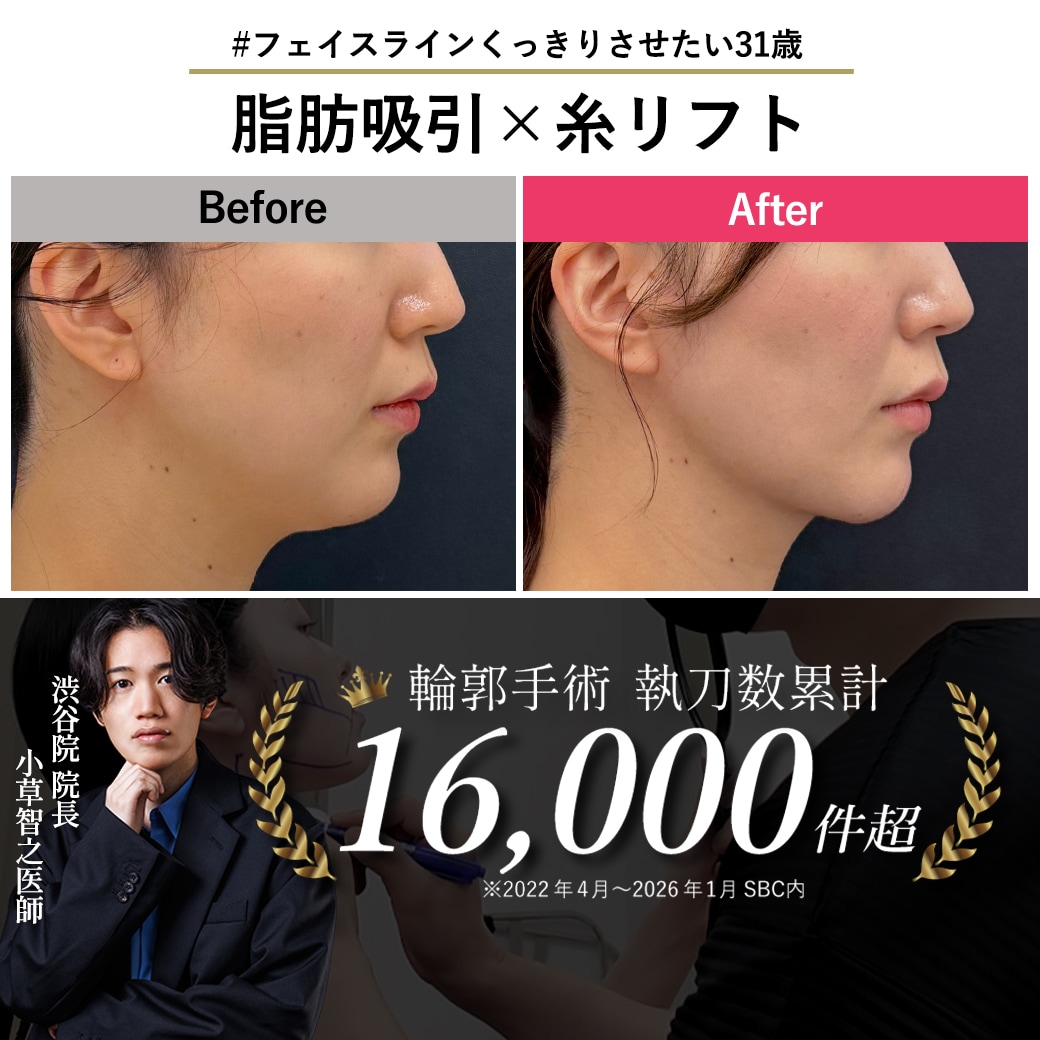 【脂肪吸引の名医】忙しくても受けられる！31歳ワーママの輪郭手術【脂肪吸引が上手いおぐさ先生】