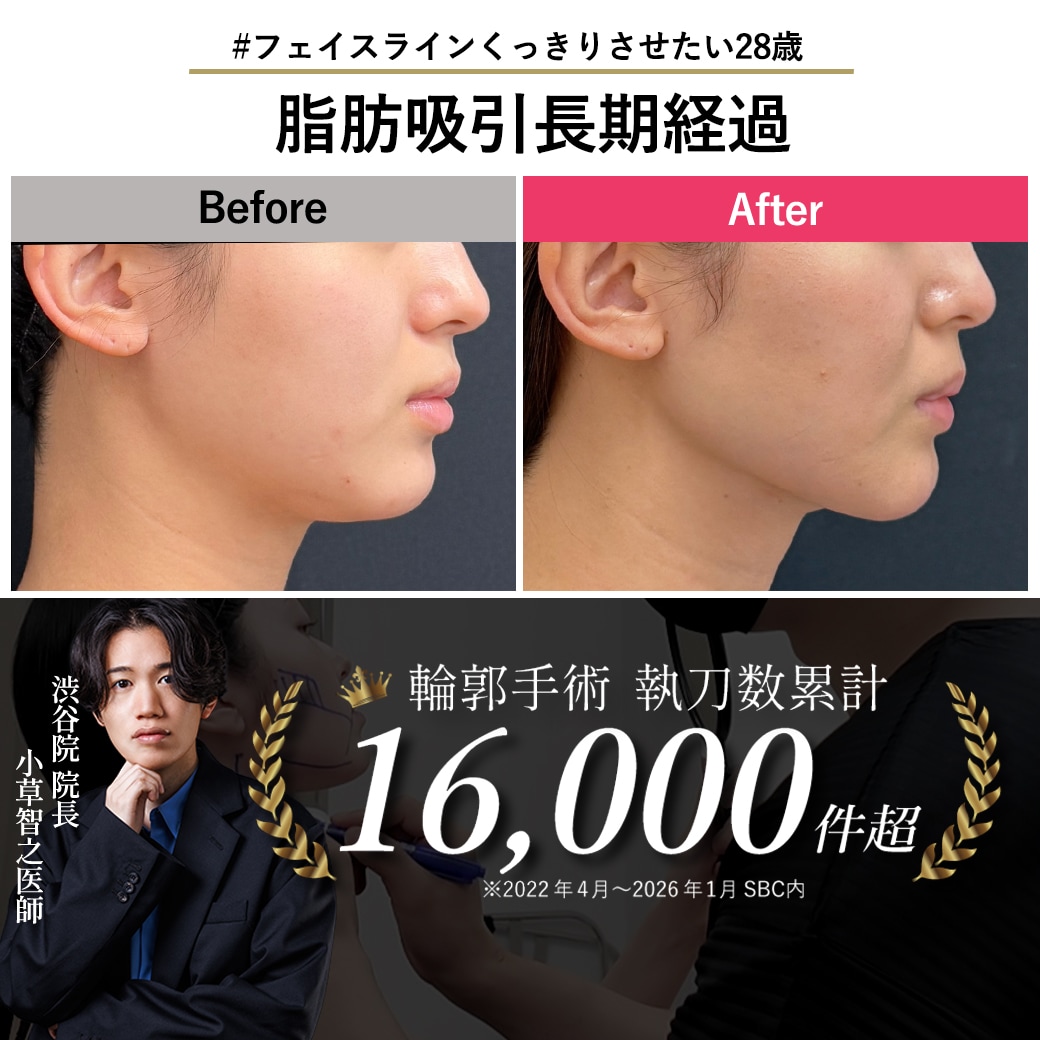 【脂肪吸引の名医】貴重！脂肪吸引400日後の経過見せます【脂肪吸引が上手い小草先生】