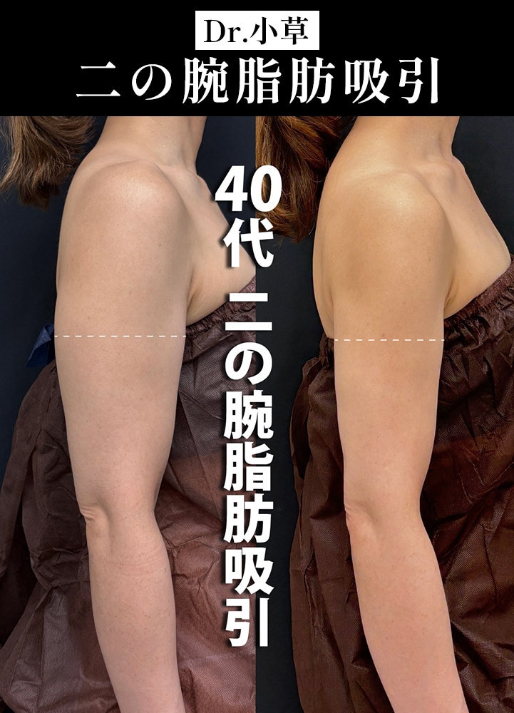 44歳のモニター様