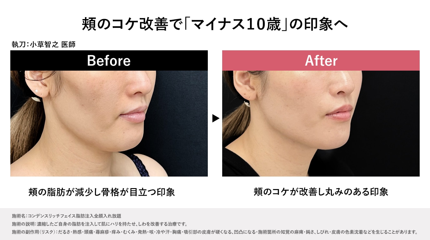 症例写真で見る「脂肪注入」で変わるホホのコケ