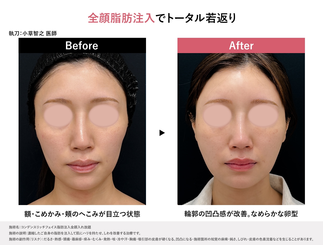 額・こめかみ・頬・ほうれい線・目の下ゴルゴに脂肪注入