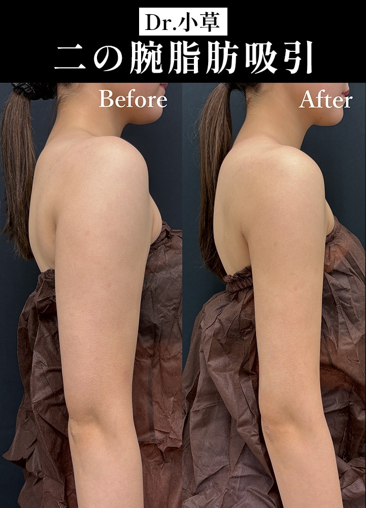 【二の腕脂肪吸引の名医】「二の腕たくましいねって言われて…」24歳の二の腕脂肪吸引【二の腕脂肪吸引が上手い小草先生】