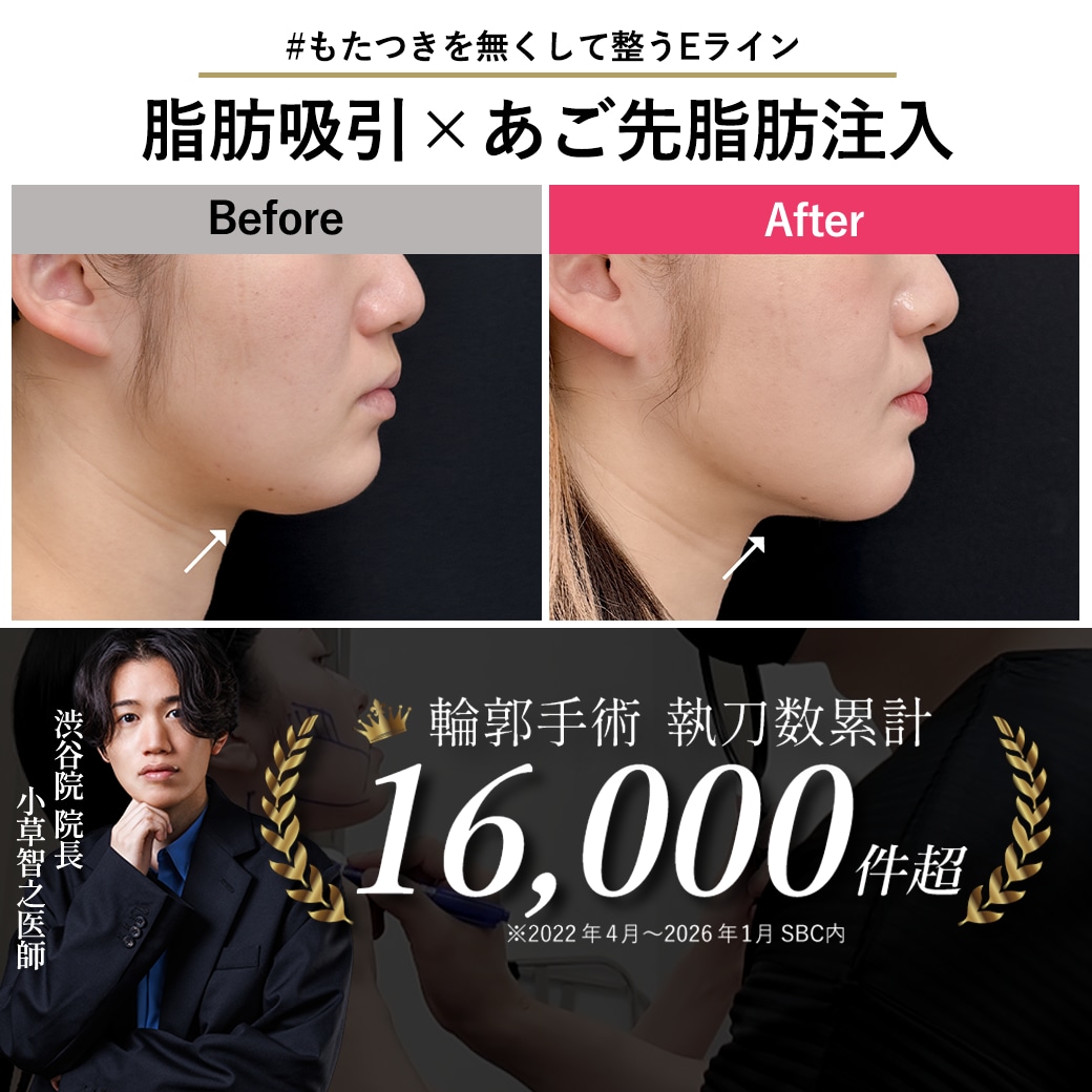 【顔　脂肪吸引の名医】顎下の厚みを無くしてシャープなVラインを叶えるトータル小顔術【脂肪吸引が上手いおぐさ先生】