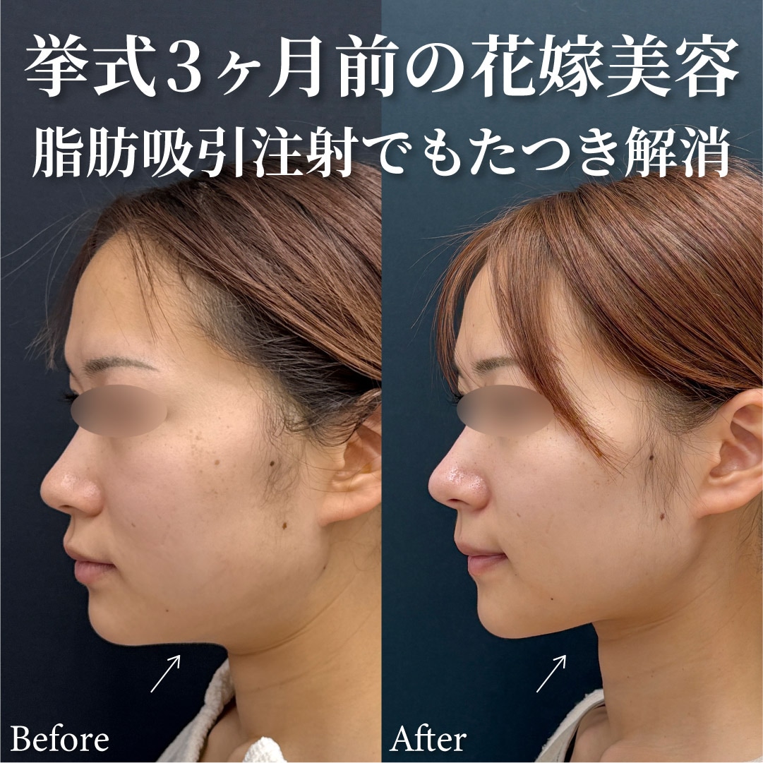 28歳女性のモニター様