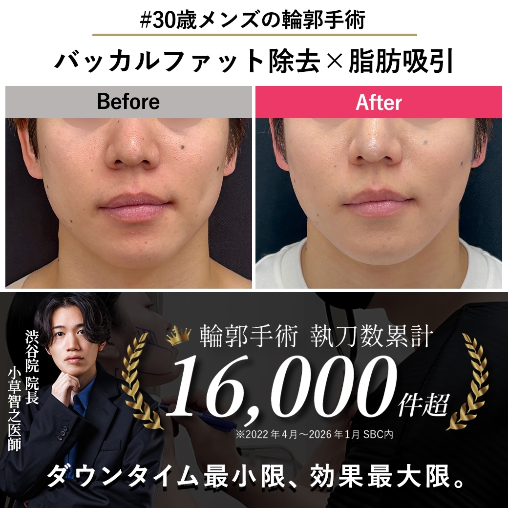 【顔の脂肪吸引の名医】30歳メンズの輪郭手術【脂肪吸引が上手いおぐさ先生】
