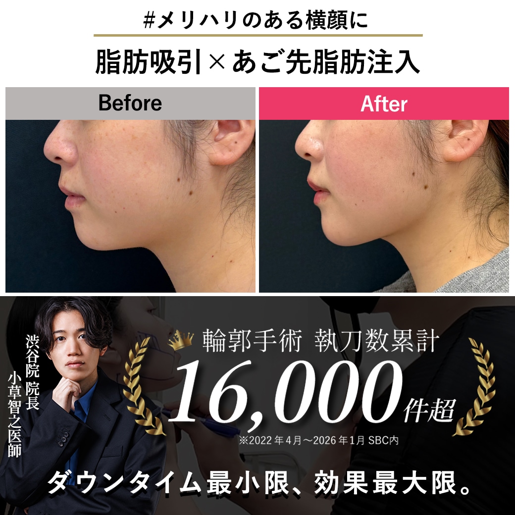 【顔の脂肪吸引の名医】あご先脂肪注入で横顔を整える【脂肪吸引が上手いおぐさ先生】