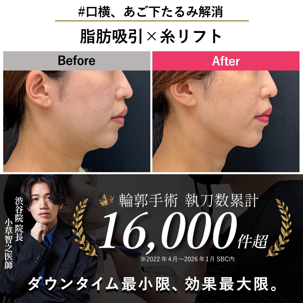 【顔の脂肪吸引の名医】34歳、糸リフト併用で自然に若返り【脂肪吸引が上手いおぐさ先生】