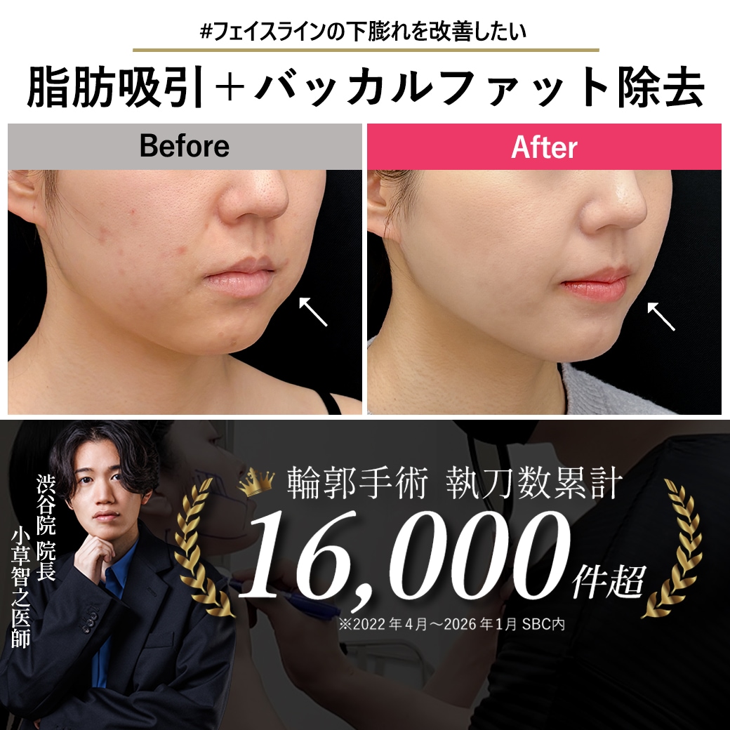 【顔脂肪吸引の名医】バッカルファット除去で変わる下膨れ改善!【脂肪吸引が上手いおぐさ先生】