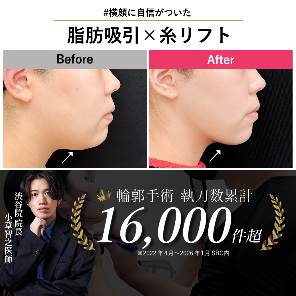 【顔脂肪吸引の名医】横顔コンプレックスを克服！20代で「二重アゴ卒業」して理想のEラインに【脂肪吸引が上手いおぐさ先生】