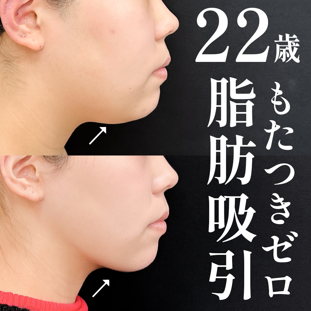 20代女性のモニター様