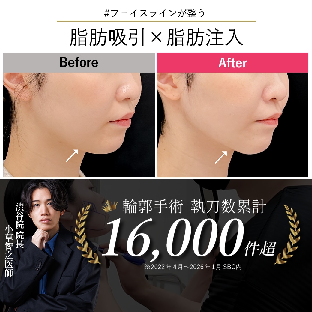 【顔脂肪吸引の名医】友達から大絶賛！脂肪吸引×メーラー除去×あご注入で垢抜ける「360度美人の小顔デザイン」