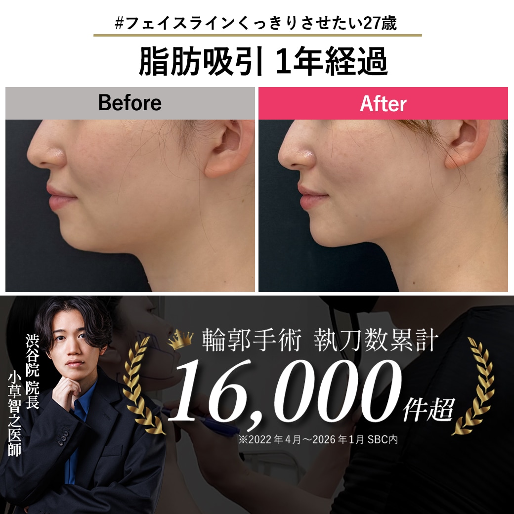 【顔の脂肪吸引の名医】脂肪吸引は戻る?1年後のリアルな経過を公開【脂肪吸引が上手いおぐさ先生】
