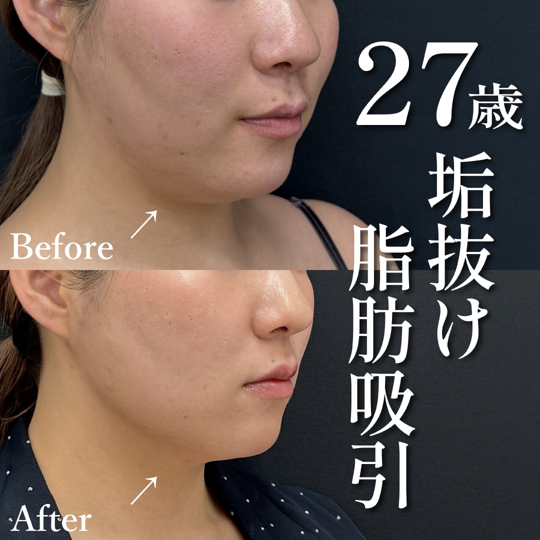 27歳女性のモニター様